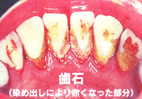 歯石（染め出しにより赤くなった部分）